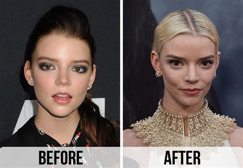 anya taylor-joy surgery|Fans Think Anya Taylor